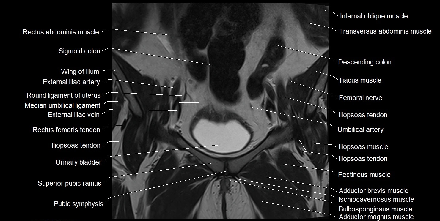 female pelvis coronal cross sectional anatomy image 10.webp